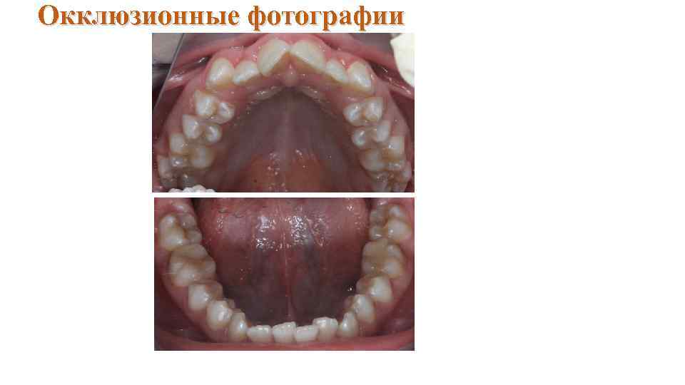 Окклюзионные фотографии 