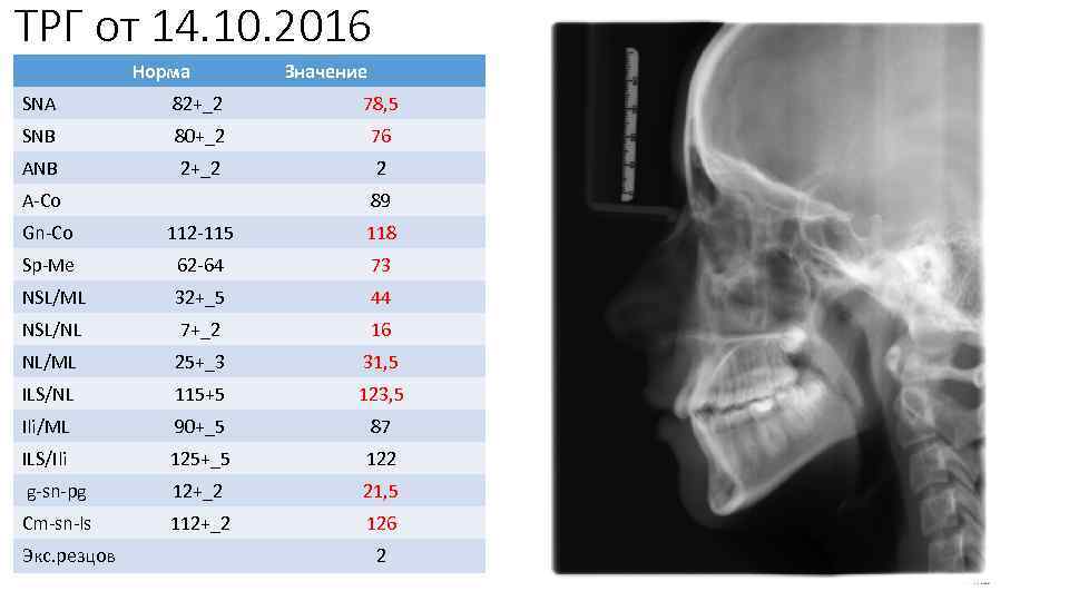 Угол spp mp. ТРГ В боковой проекции норма. Угол АНБ на ТРГ норма. ТРГ углы. Угол sna на ТРГ.
