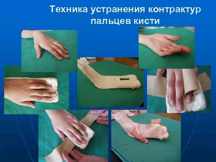 Техника устранения контрактур пальцев кисти 