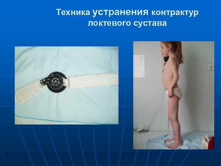Техника устранения контрактур локтевого сустава 