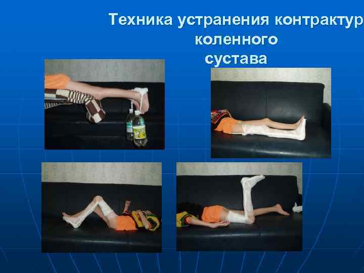Техника устранения контрактур коленного сустава 