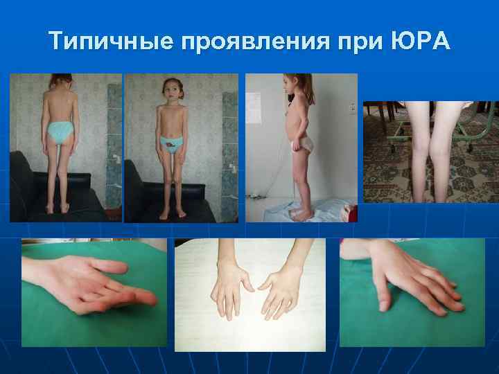Типичные проявления при ЮРА 