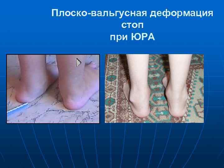 Плоско-вальгусная деформация стоп при ЮРА 