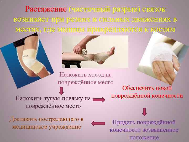 Растяжение (частичный разрыв) связок возникает при резких и сильных движениях в местах, где мышцы