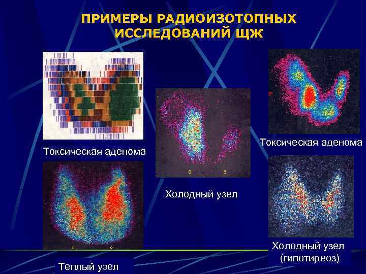 ПРИМЕРЫ РАДИОИЗОТОПНЫХ ИССЛЕДОВАНИЙ ЩЖ Токсическая аденома Холодный узел Теплый узел Холодный узел (гипотиреоз) 