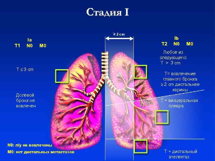 Стадия I. 2 cm Ib Тх Ia недостаточно данных для оценки первичной опухоли, или