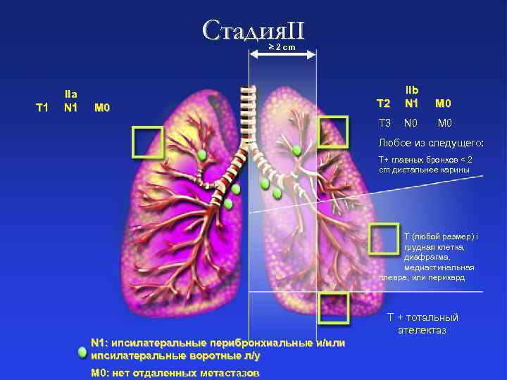 Стадия. II 2 cm T 1 IIa N 1 T 2 M 0 T
