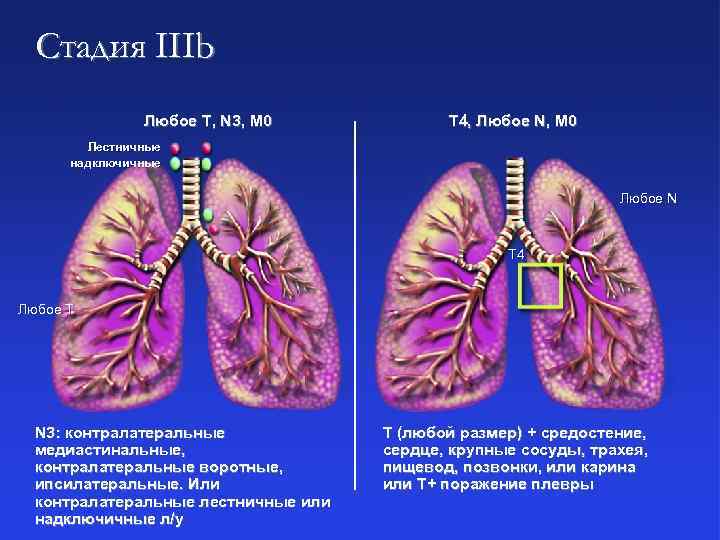 Стадия IIIb Любое T, N 3, M 0 T 4, Любое N, M 0