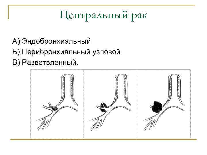 Центральный рак А) Эндобронхиальный Б) Перибронхиальный узловой В) Разветвленный. 