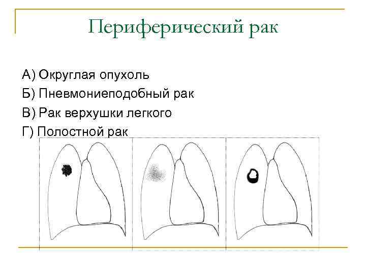Периферический рак А) Округлая опухоль Б) Пневмониеподобный рак В) Рак верхушки легкого Г) Полостной