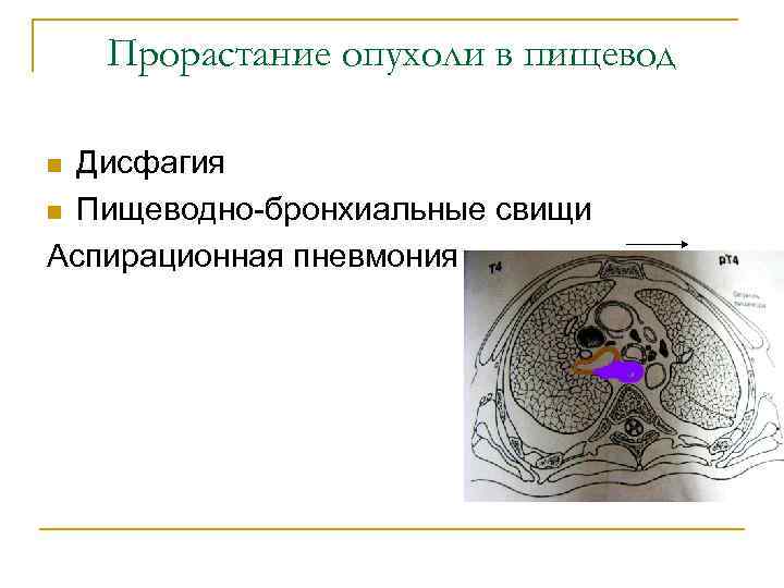 Прорастание опухоли в пищевод Дисфагия n Пищеводно-бронхиальные свищи Аспирационная пневмония n 