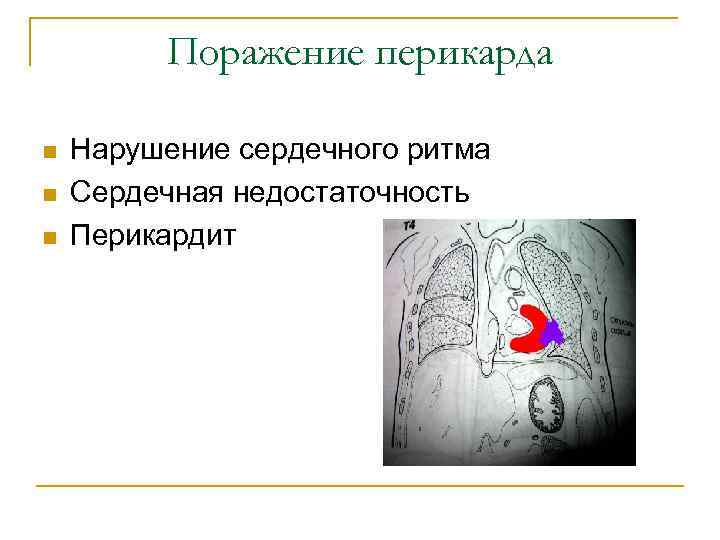 Поражение перикарда n n n Нарушение сердечного ритма Сердечная недостаточность Перикардит 