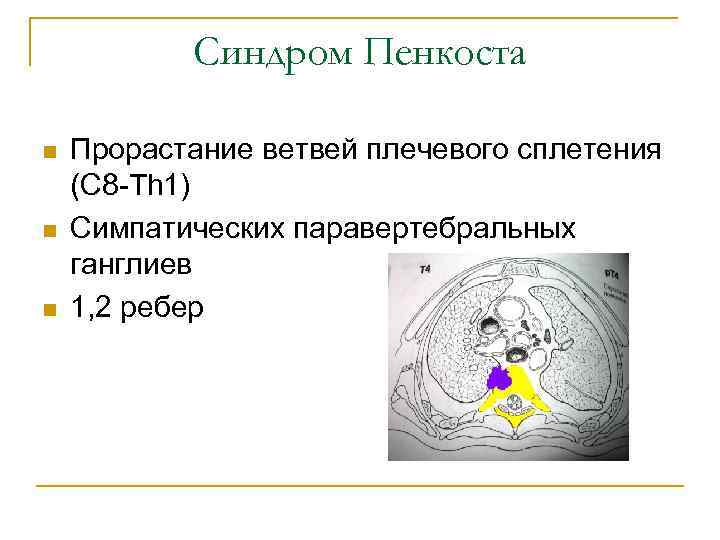 Синдром Пенкоста n n n Прорастание ветвей плечевого сплетения (C 8 -Th 1) Симпатических