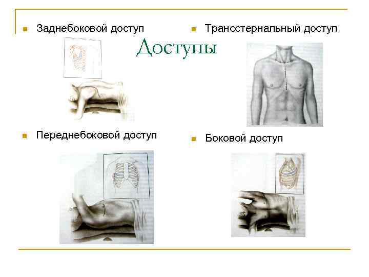 n Заднебоковой доступ n Трансстернальный доступ Доступы n Переднебоковой доступ n Боковой доступ 