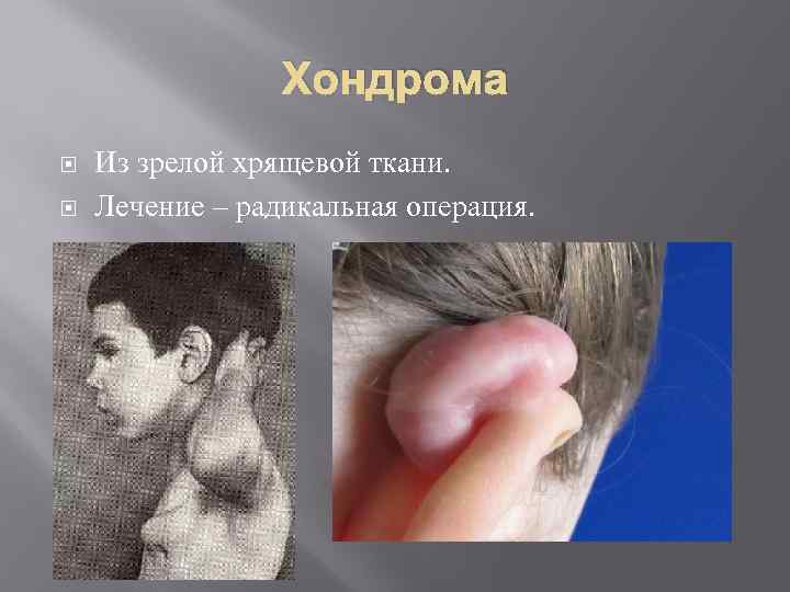Хондрома Из зрелой хрящевой ткани. Лечение – радикальная операция. 