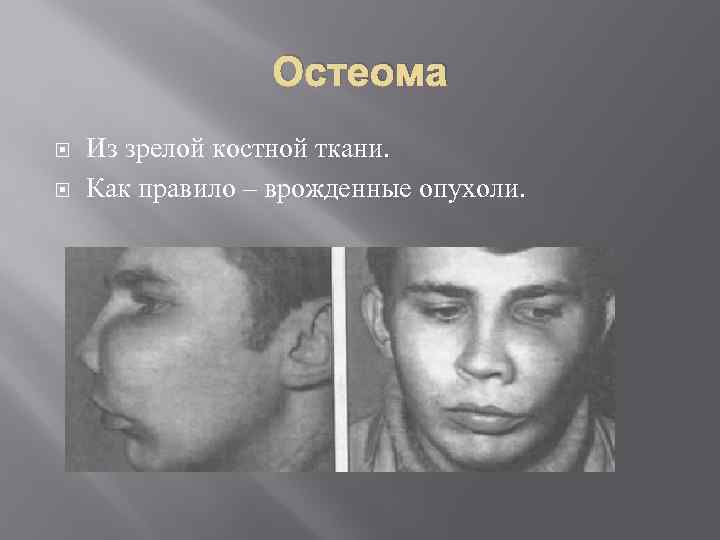 Остеома Из зрелой костной ткани. Как правило – врожденные опухоли. 