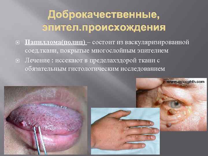 Доброкачественные, эпител. происхождения Папиллома(полип) – состоит из васкуляризированной соед. ткани, покрытые многослойным эпителием Лечение