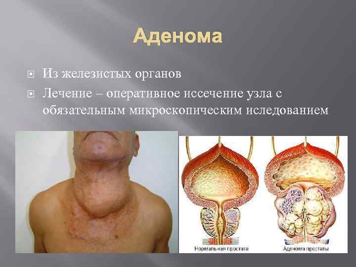 Аденома Из железистых органов Лечение – оперативное иссечение узла с обязательным микроскопическим иследованием 