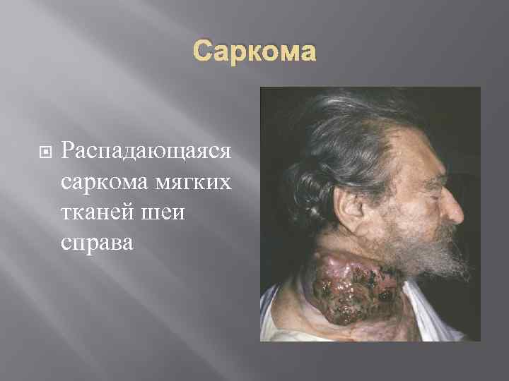 Саркома Распадающаяся саркома мягких тканей шеи справа 