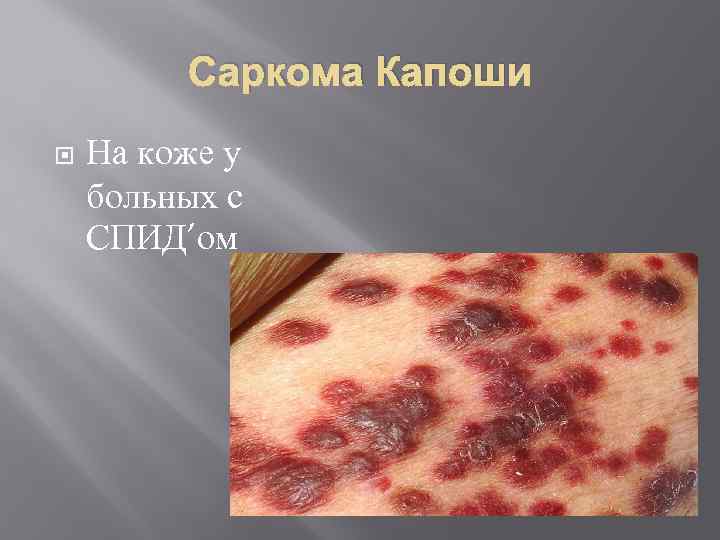 Саркома Капоши На коже у больных с СПИД’ом 
