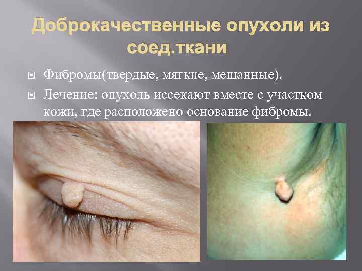 Доброкачественные опухоли из соед. ткани Фибромы(твердые, мягкие, мешанные). Лечение: опухоль иссекают вместе с участком