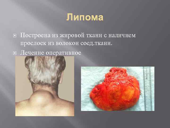 Липома Построена из жировой ткани с наличием прослоек из волокон соед. ткани. Лечение оперативное
