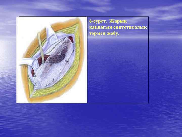 6 -сурет. Жарық қақпағын синтетикалық тормен жабу. 