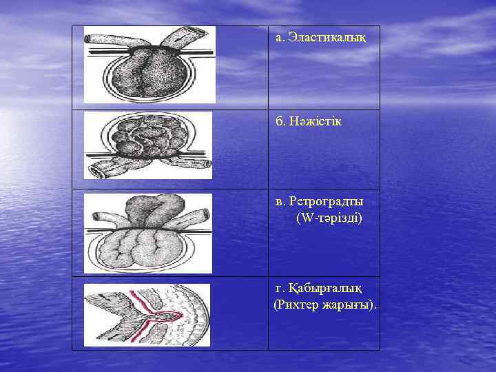 а. Эластикалық б. Нәжістік в. Ретроградты (W-тәрізді) г. Қабырғалық (Рихтер жарығы). 