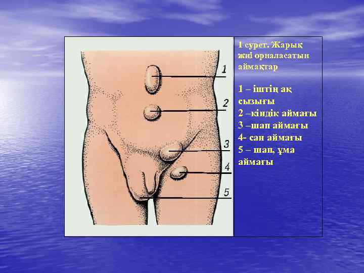 1 сурет. Жарық жиі орналасатын аймақтар 1 – іштің ақ сызығы 2 –кіндік аймағы