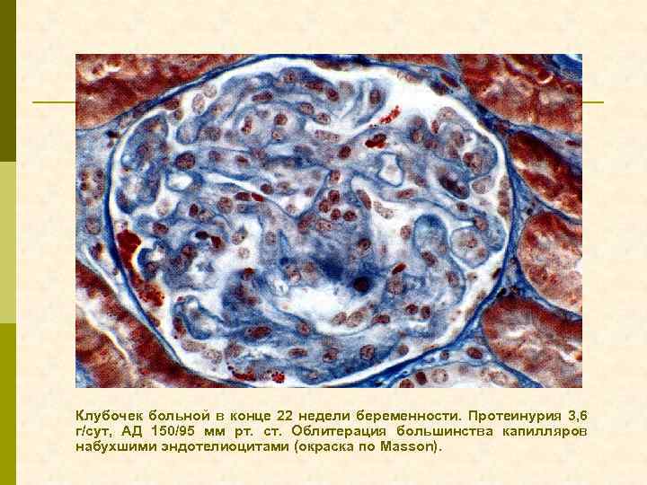 Клубочек больной в конце 22 недели беременности. Протеинурия 3, 6 г/сут, АД 150/95 мм