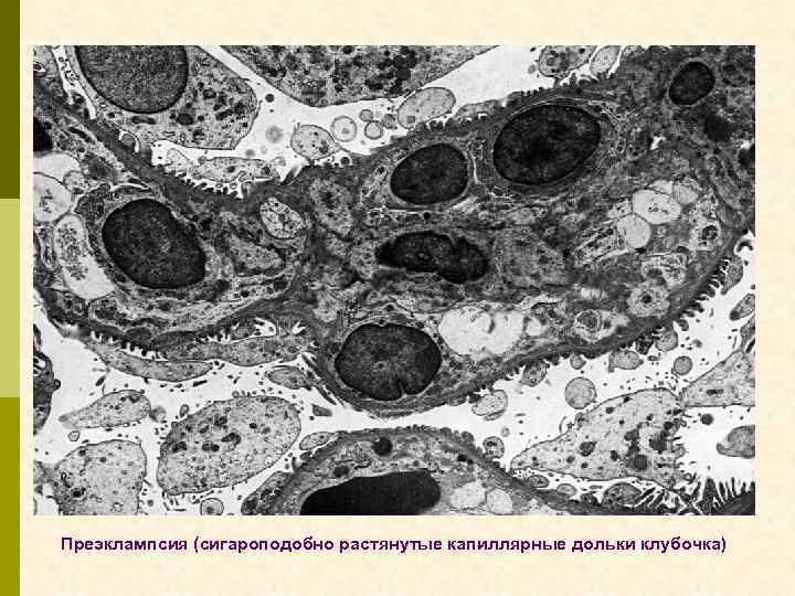 Преэклампсия (сигароподобно растянутые капиллярные дольки клубочка) 