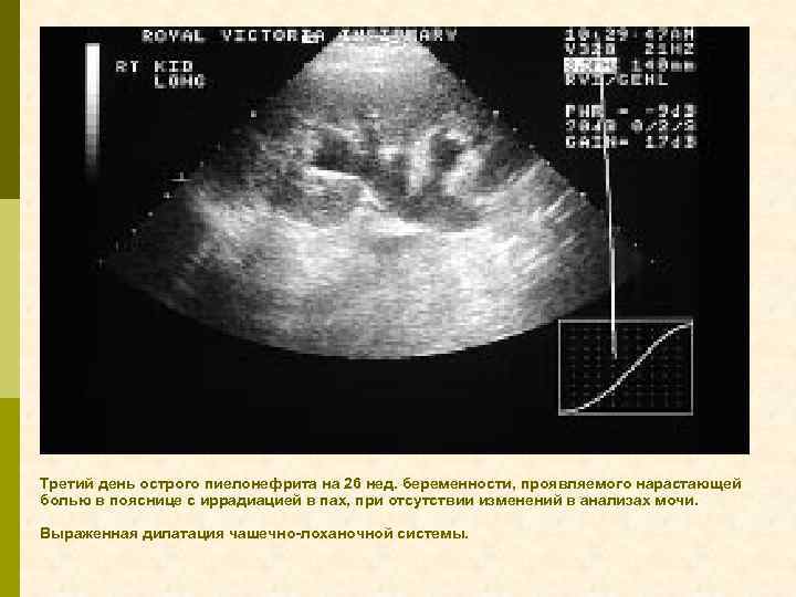 Третий день острого пиелонефрита на 26 нед. беременности, проявляемого нарастающей болью в пояснице с