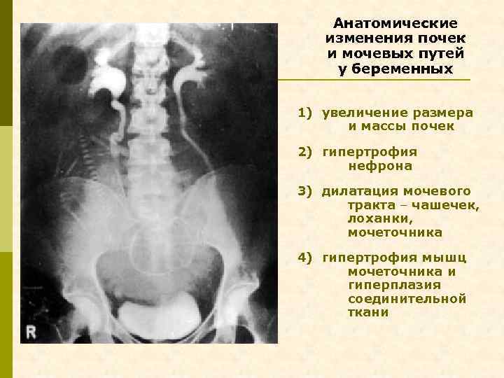 Анатомические изменения почек и мочевых путей у беременных 1) увеличение размера и массы почек