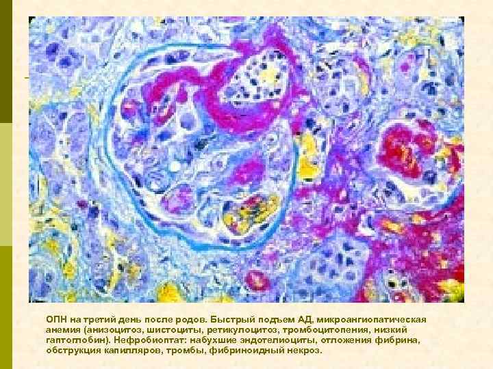 ОПН на третий день после родов. Быстрый подъем АД, микроангиопатическая анемия (анизоцитоз, шистоциты, ретикулоцитоз,