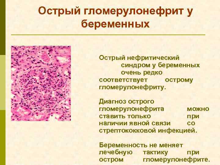 Острый гломерулонефрит у беременных Острый нефритический синдром у беременных очень редко соответствует острому гломерулонефриту.