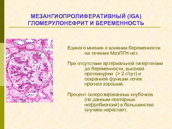 МЕЗАНГИОПРОЛИФЕРАТИВНЫЙ (IGA) ГЛОМЕРУЛОНЕФРИТ И БЕРЕМЕННОСТЬ Единого мнения о влиянии беременности на течение Мез. ПГН