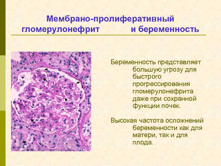 Мембрано-пролиферативный гломерулонефрит и беременность Беременность представляет большую угрозу для быстрого прогрессирования гломерулонефрита даже при