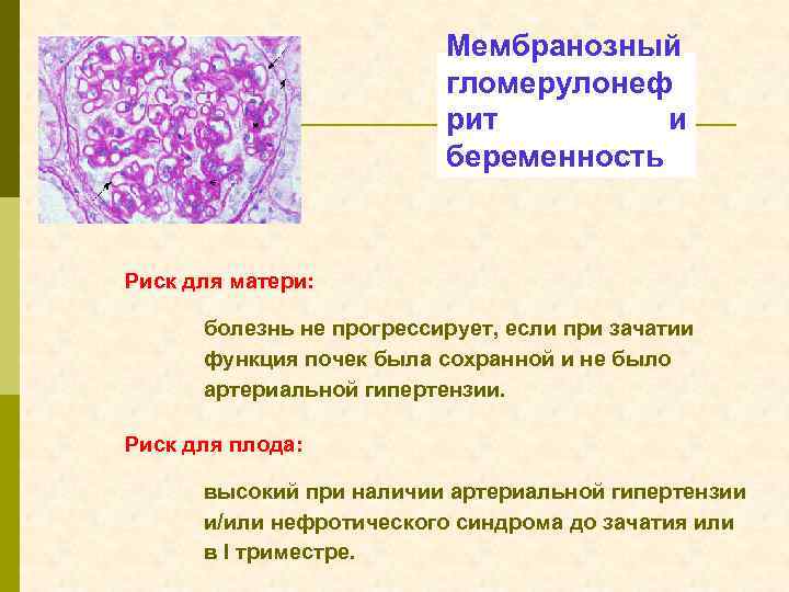 Мембранозный гломерулонеф рит и беременность Риск для матери: болезнь не прогрессирует, если при зачатии