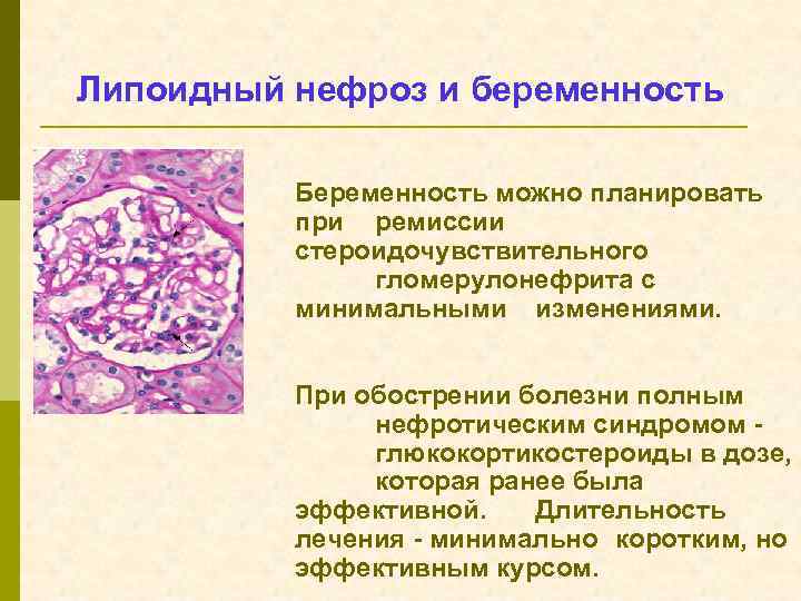 Липоидный нефроз и беременность Беременность можно планировать при ремиссии стероидочувствительного гломерулонефрита с минимальными изменениями.