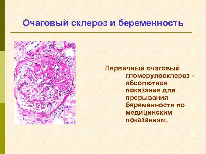 Очаговый склероз и беременность Первичный очаговый гломерулосклероз абсолютное показание для прерывания беременности по медицинским