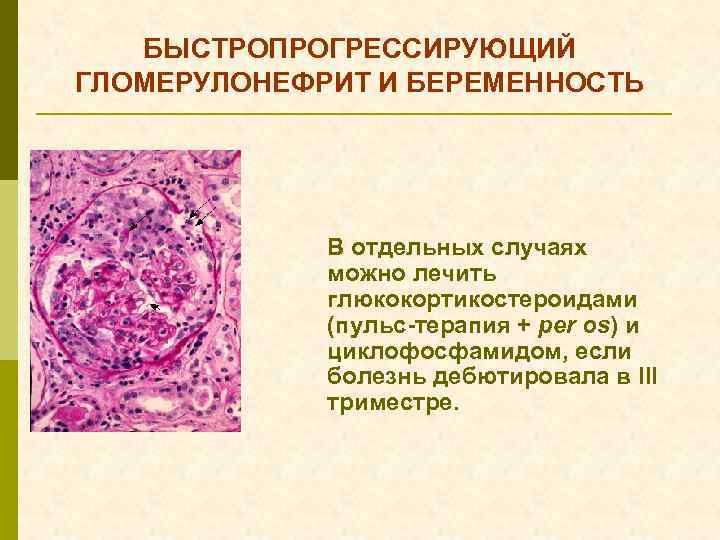 БЫСТРОПРОГРЕССИРУЮЩИЙ ГЛОМЕРУЛОНЕФРИТ И БЕРЕМЕННОСТЬ В отдельных случаях можно лечить глюкокортикостероидами (пульс-терапия + per os)