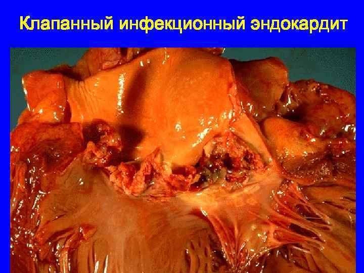 Клапанный инфекционный эндокардит 