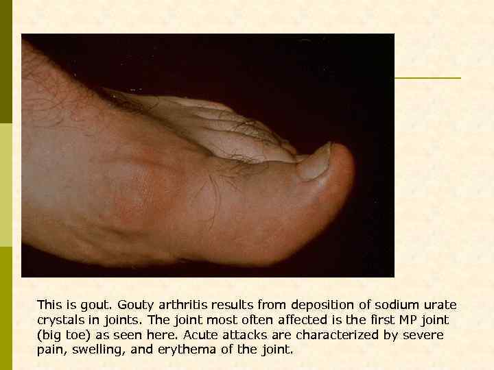This is gout. Gouty arthritis results from deposition of sodium urate crystals in joints.