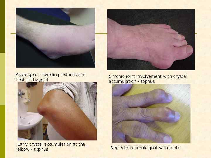 Acute gout - swelling redness and heat in the joint Early crystal accumulation at