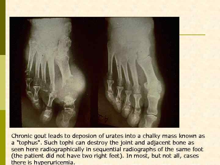Chronic gout leads to deposion of urates into a chalky mass known as a