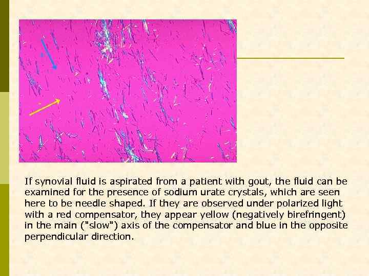 If synovial fluid is aspirated from a patient with gout, the fluid can be