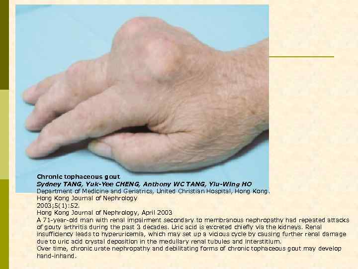 Chronic tophaceous gout Sydney TANG, Yuk-Yee CHENG, Anthony WC TANG, Yiu-Wing HO Department of