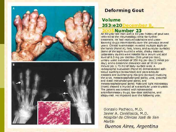 Deforming Gout Volume 353: e 20 December 8, 2005 Number 23 An 80 -year-old