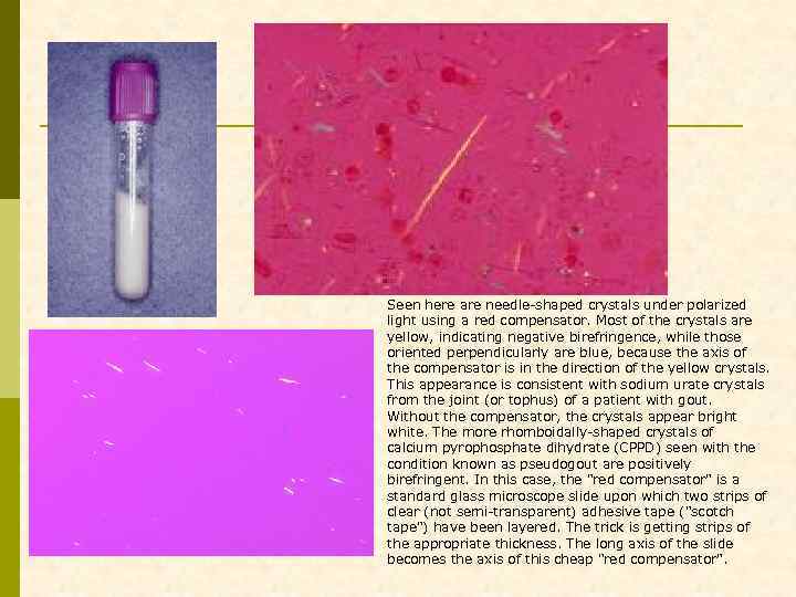 Seen here are needle-shaped crystals under polarized light using a red compensator. Most of