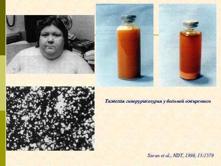 Тяжелая гиперурикозурия у больной ожирением Saran et al. , NDT, 1998, 13: 1579 